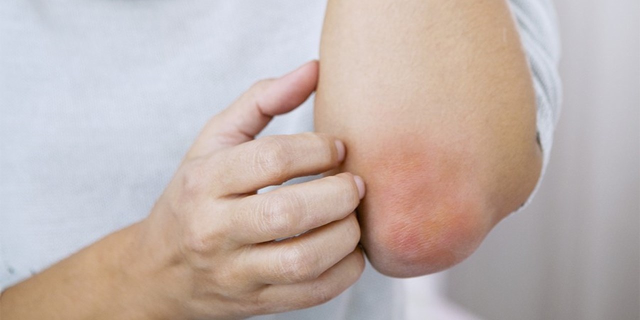 Фонд «ПОДСОЛНУХ» приглашает пациентов с диагнозом «псориаз» и их близких на встречу